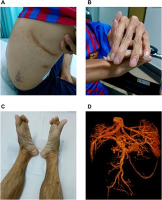 Importance of comprehensive genetic testing for patients with suspected vascular Ehlers–Danlos syndrome: a family case report and literature review